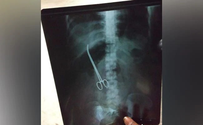 পেটে কাঁচি রেখে ভুলে গেলেন চিকিৎসক, ৩ মাস পর ধরা পড়ল এক্স রে’তে