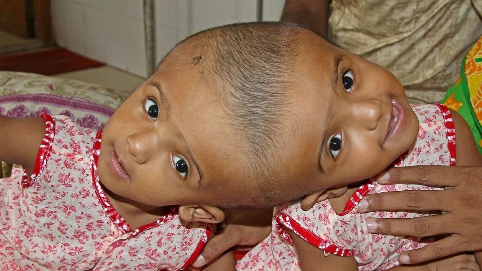 টানা ৩০ ঘণ্টা অস্ত্রোপচারের পর পৃথক হলো জোড়া মাথার রাবেয়া-রোকাইয়া