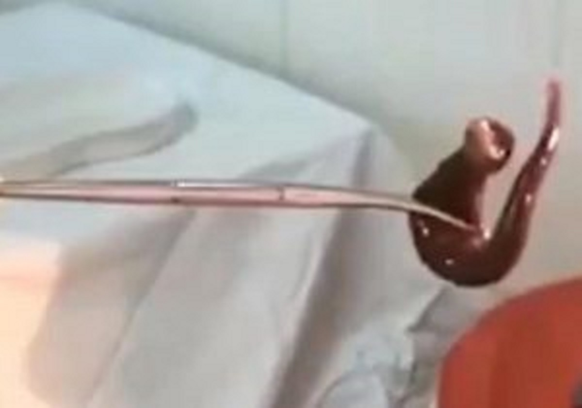 শাক তুলতে গিয়ে স্কুলছাত্রীর পেটে জোঁক