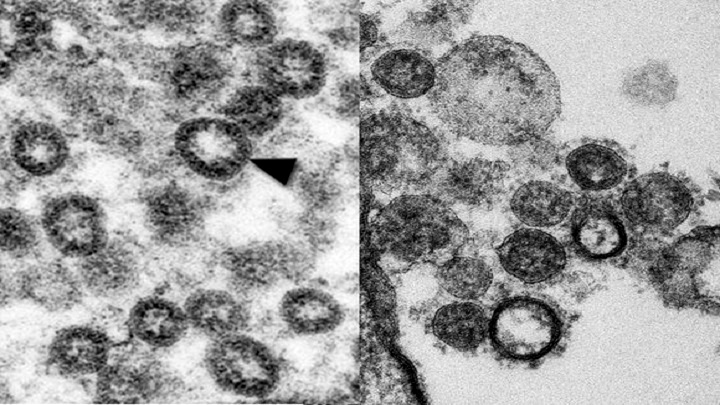সময়ের সাথে জটিল হচ্ছে করোনার চরিত্র, সাথে নতুন উপসর্গ