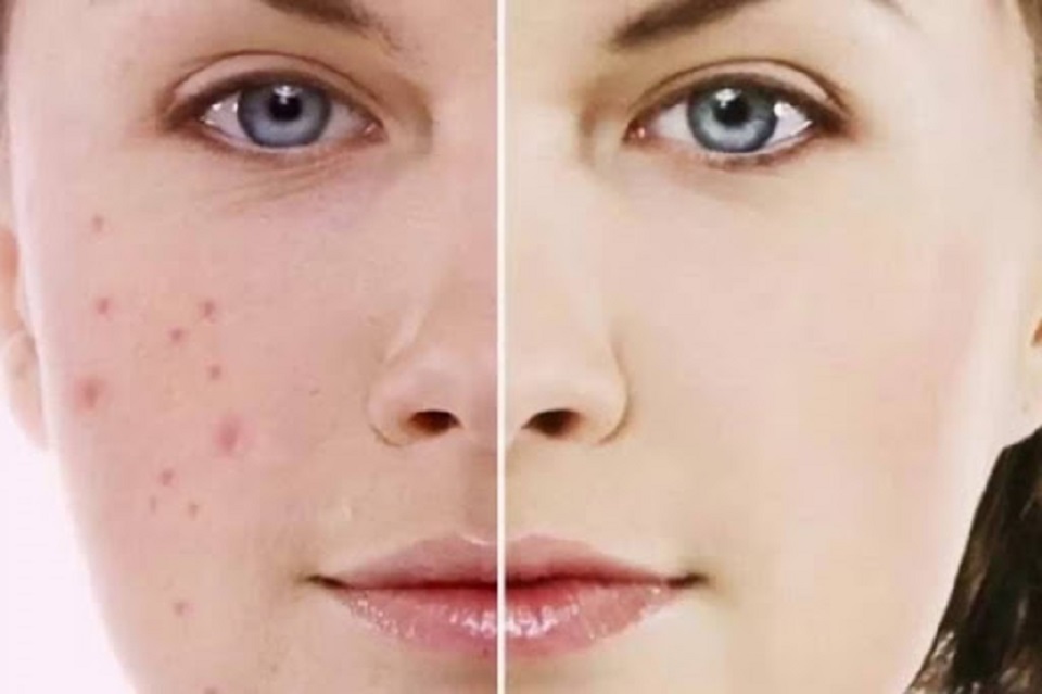 ব্রণের দাগ দূর করার ঘরোয়া উপায়