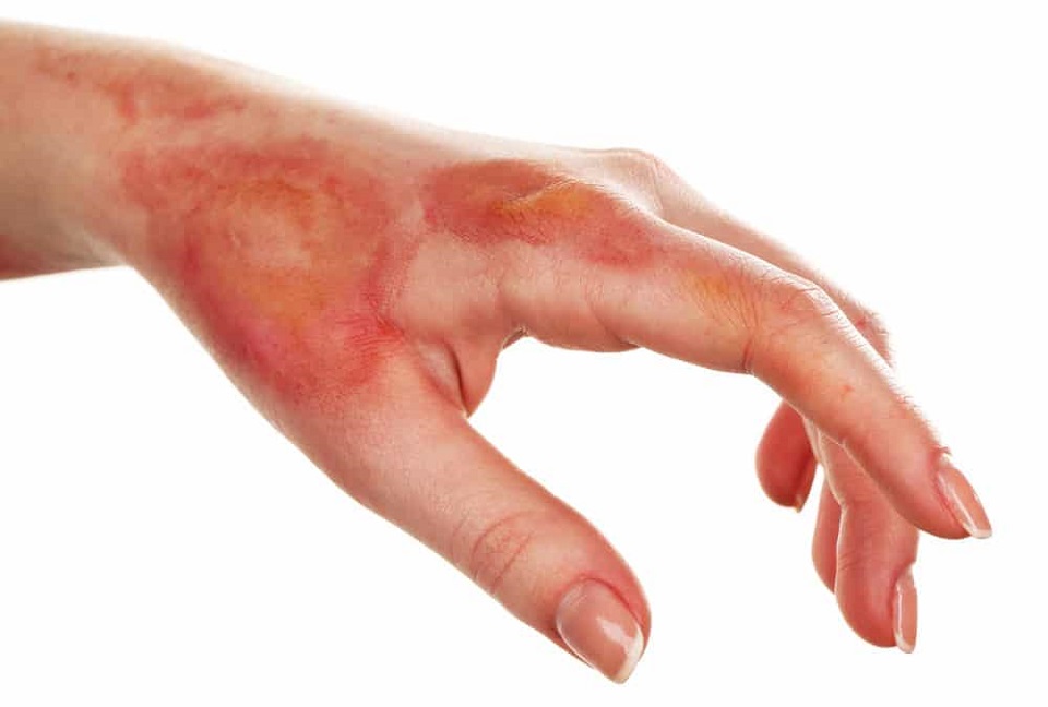 শরীরের কোন অংশ পুড়লে যা করবেন