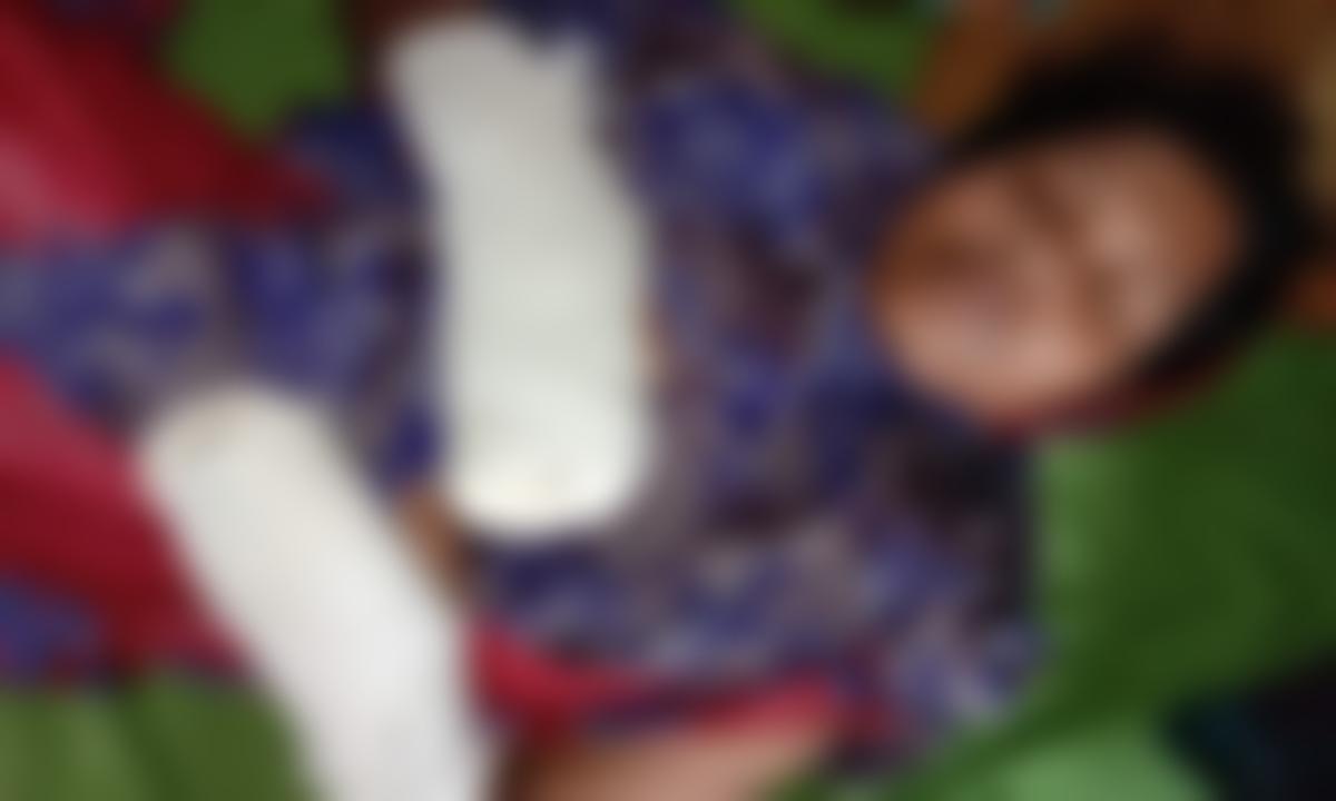 ভোলায় যৌতুকের দাবিতে গৃহবধূর দু’হাত ভেঙে দিলো স্বামী