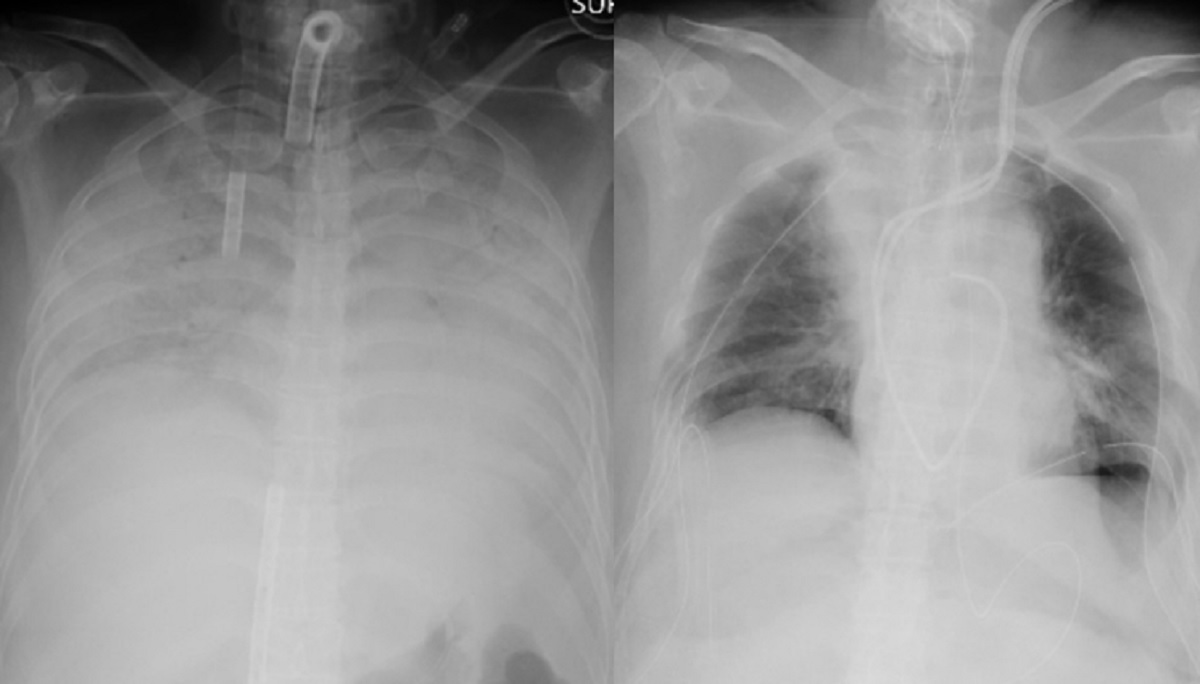 বিশ্বে প্রথম জীবিত ব্যক্তির দেহ থেকে ফুসফুস প্রতিস্থাপন করলো জাপান