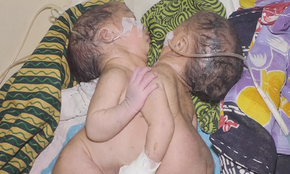 শরীর জোড়া লাগা দুই শিশুর জন্ম!