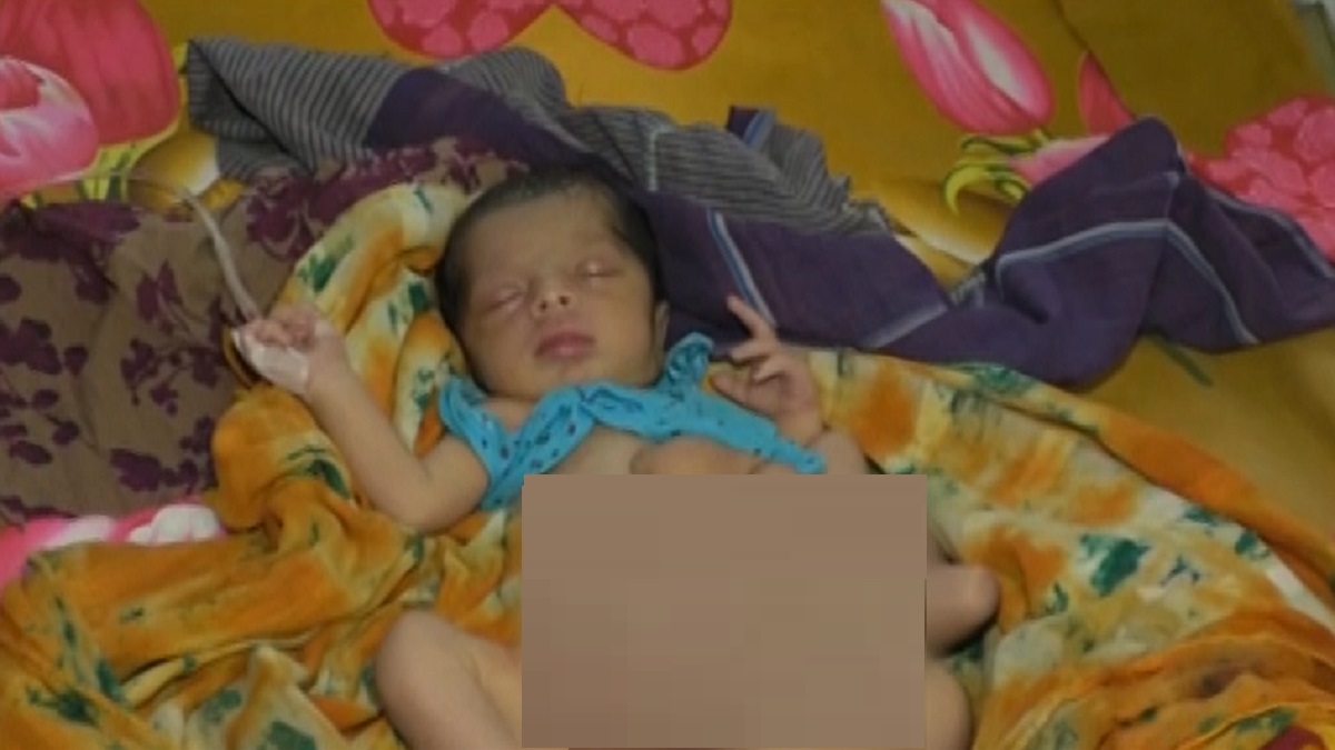 রংপুরে জন্ম নিলো প্যারাসাইটিক টুইন