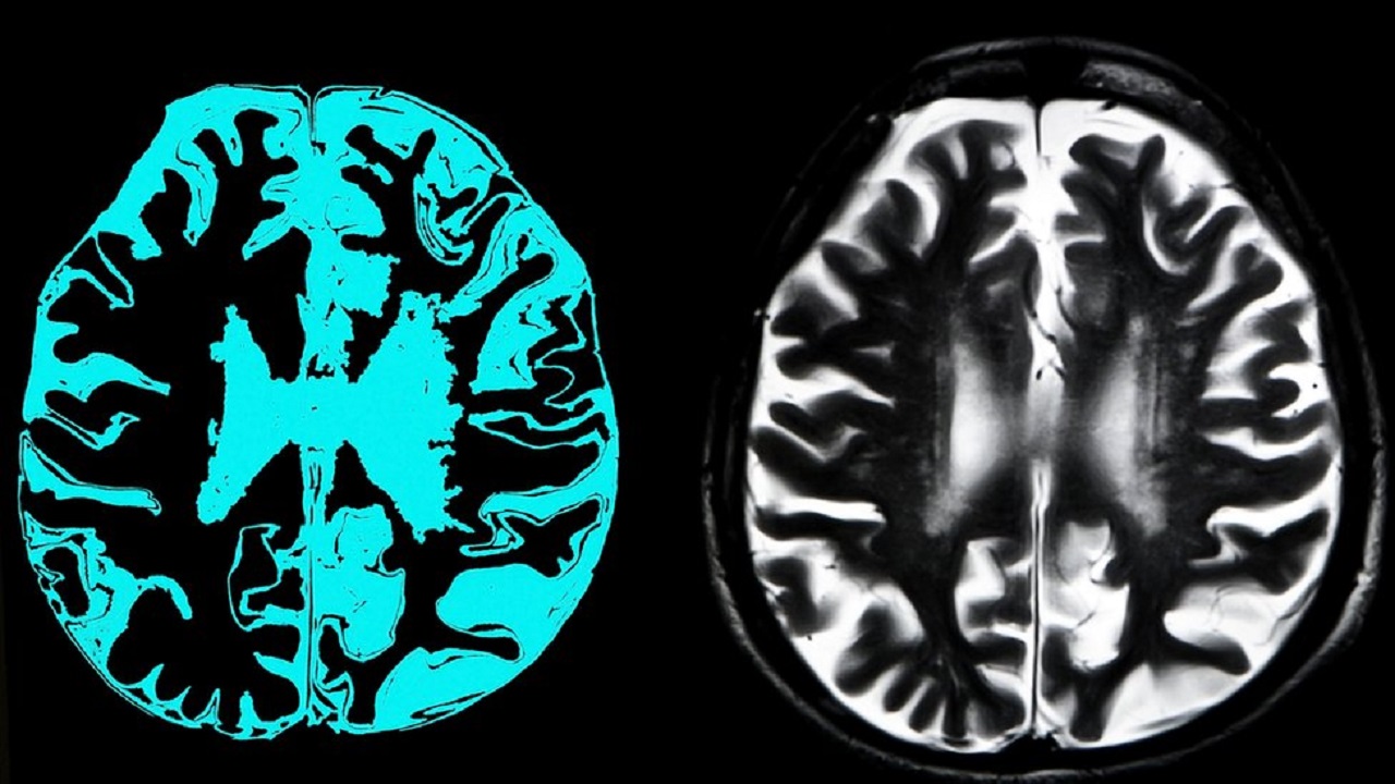 বিশ্বে প্রথমবারের মতো আলঝেইমারের ওষুধের অনুমোদন বিশ্বে প্রথমবারের মতো আলঝেইমারের ওষুধের অনুমোদন