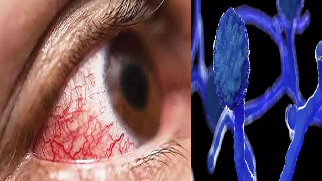 ভারতে ব্ল্যাক ফাঙ্গাস: ৩ সপ্তাহে সংক্রমণ বেড়েছে দেড় গুণ ভারতে ব্ল্যাক ফাঙ্গাস: তিন সপ্তাহে সংক্রমণ বেড়েছে দেড়'শ শতাংশ