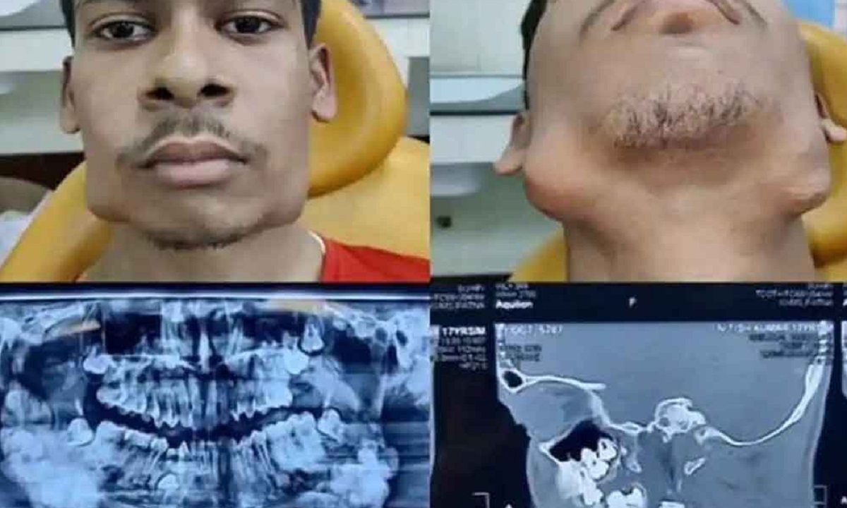 ১৭ বছরের তরুণের মুখে ১১৪টি দাঁত