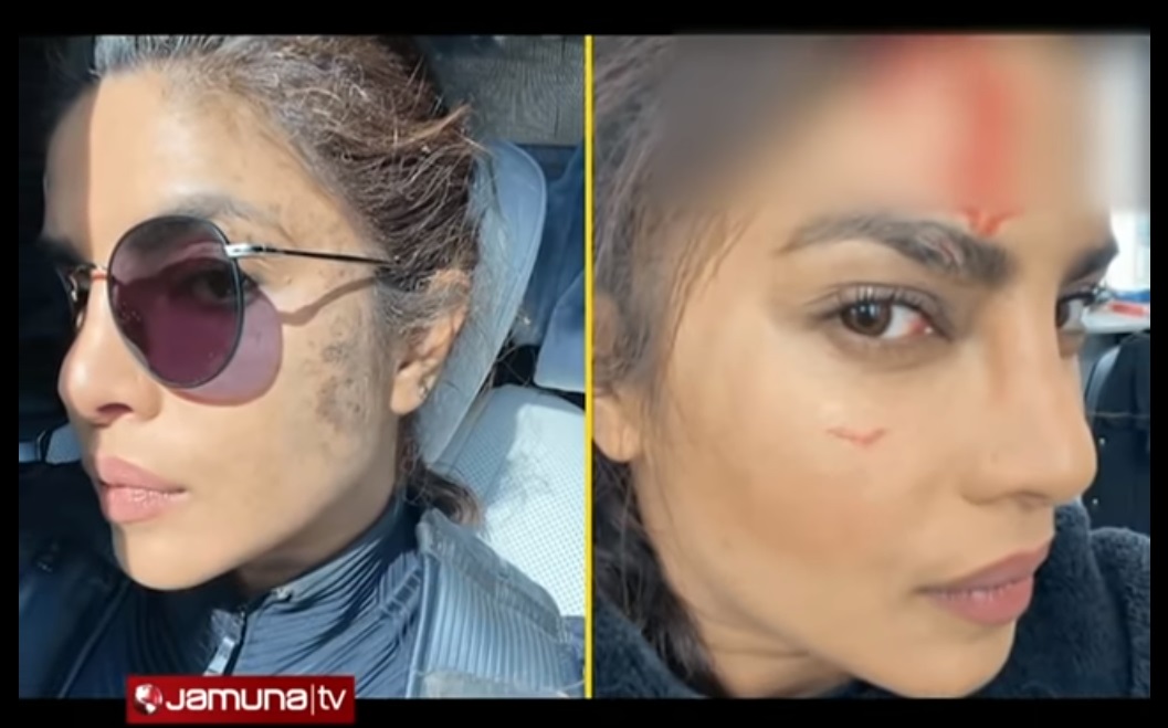 কপাল ফাটলো প্রিয়াঙ্কা চোপড়ার কপাল ফাটলো প্রিয়াঙ্কা চোপড়ার