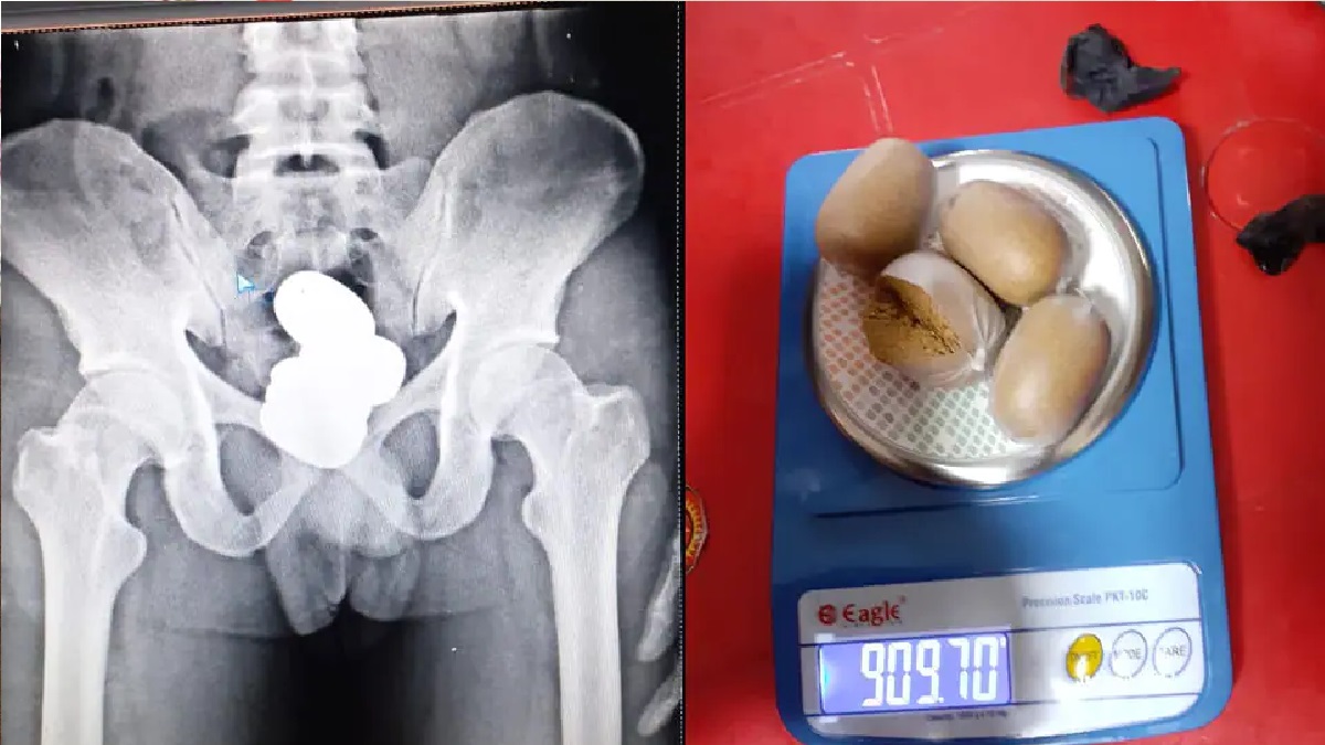 পায়ুপথে লুকিয়ে এক কেজি স্বর্ণ পাচারের চেষ্টা