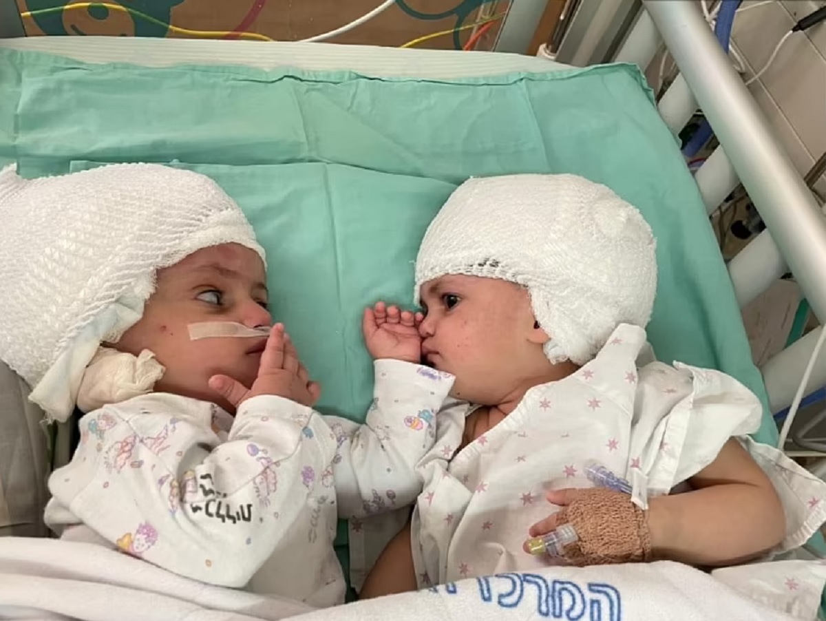 দুই বোনের এক মাথা, অবশেষে আলাদা হলো জটিল অস্ত্রপচারে