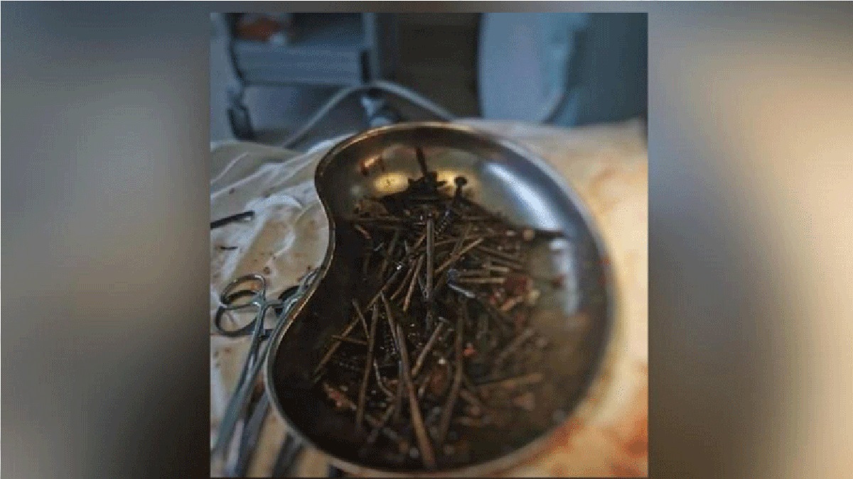 মানুষের পেটে পাওয়া গেল এক কেজি স্ক্রু ও ছুরি