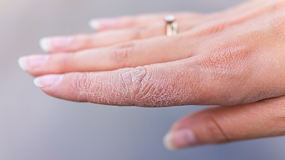 শীত আসন্ন, এখন থেকে রোধ করুন ত্বক ফাটা