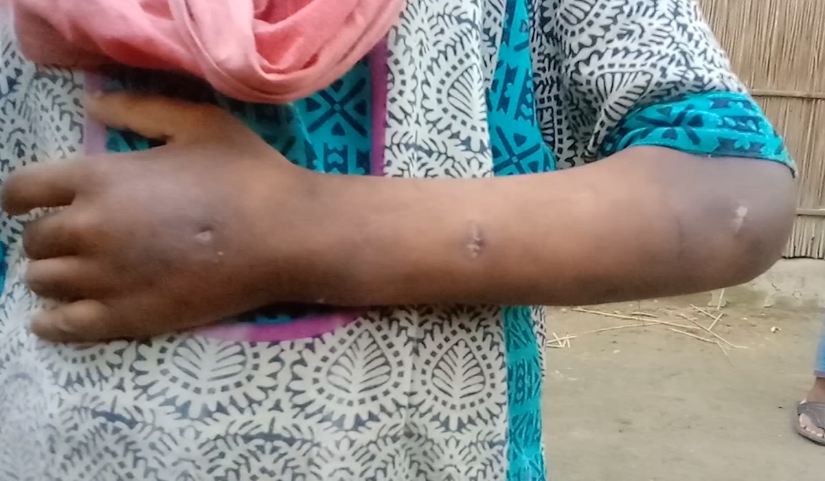 এখনও গ্রেফতার হয়নি শিশু গৃহকর্মী নির্যাতনের আসামি শাপলা