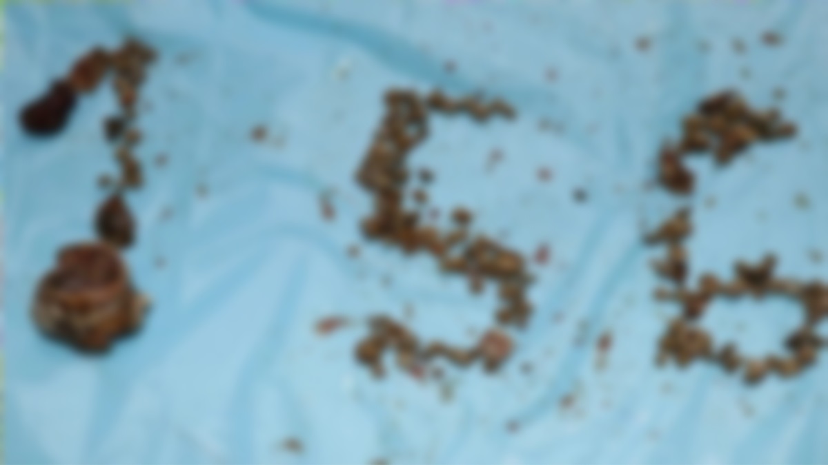 বড় অপারেশন ছাড়াই একজনের কিডনি থেকে ১৫৬টি পাথর বের করলো ডাক্তার!