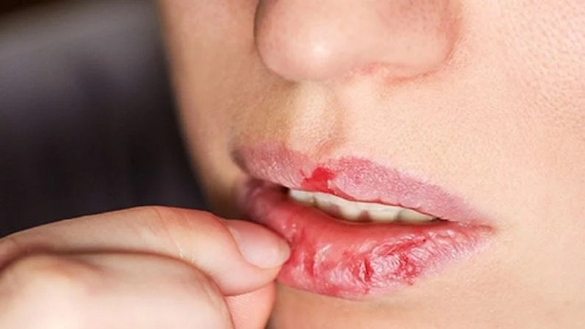 শীতে ঠোঁট ফাটছে? জেনে নিন সারানোর সহজ উপায়