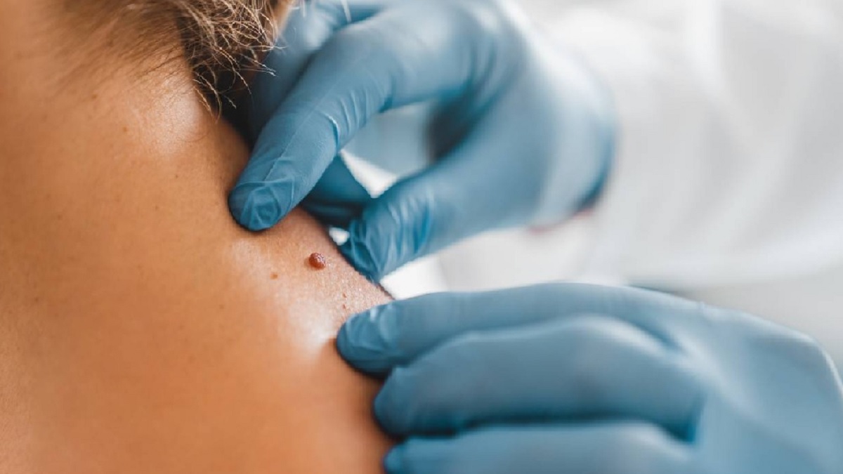 আঁচিল না ত্বকের ক্যানসারের ইঙ্গিত? যেভাবে বুঝবেন