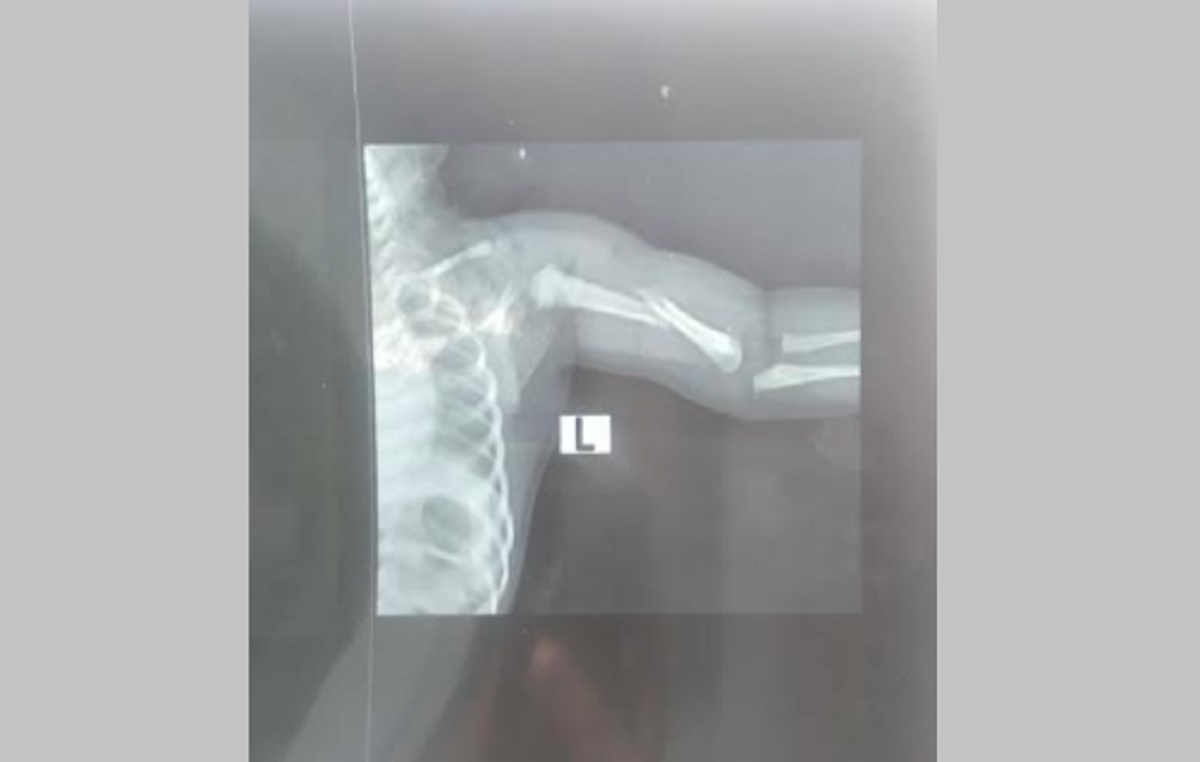 ব্রাহ্মণবাড়িয়ায় সিজারের সময় নবজাতকের হাত ভেঙে ফেলার অভিযোগ