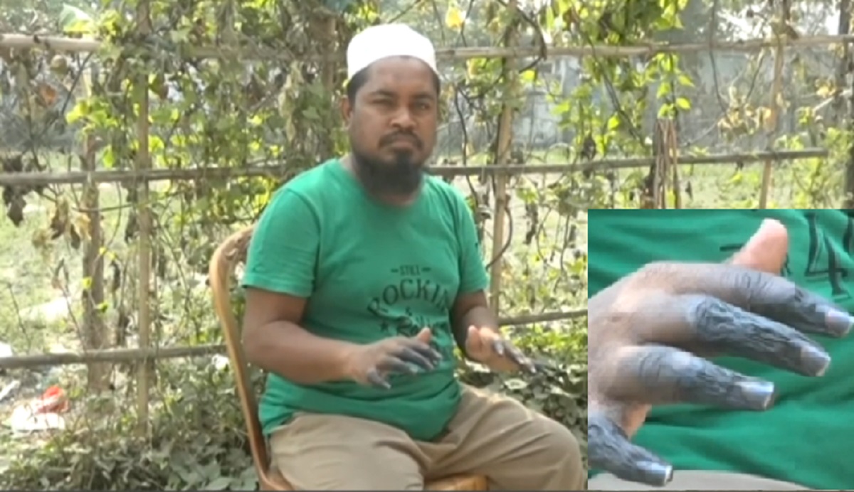 বিরল রোগে পাথরের মতো শক্ত হয়েছে আঙুল, চিকিৎসা করাতে গিয়ে নিঃস্ব পরিবার (ভিডিও)