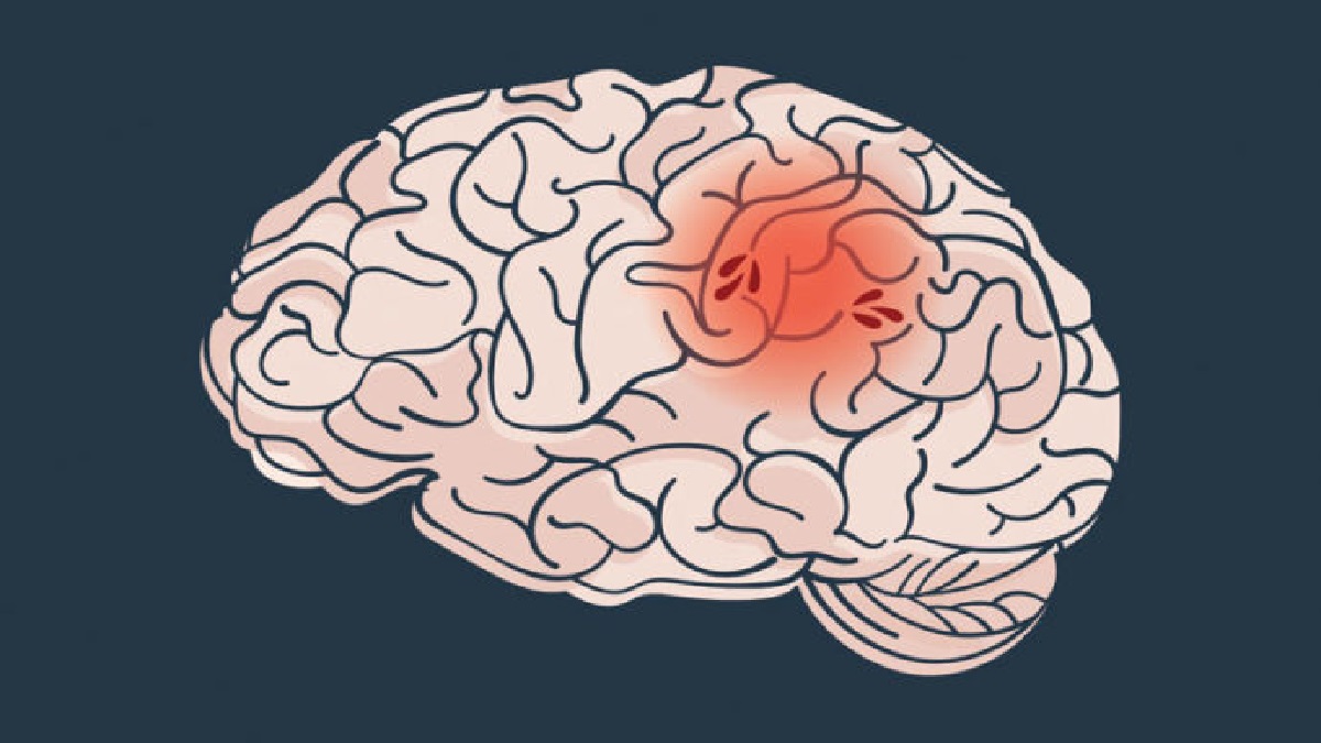 প্রথমবার স্ট্রোকের ১০ বছরের মধ্যে মারা যান অধিকাংশ রোগী: সমীক্ষা