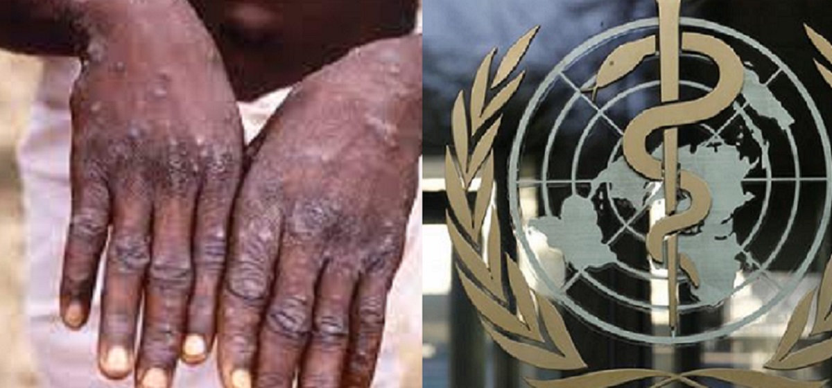 মাঙ্কিপক্স নিয়ে এবার মুখ খুললো বিশ্ব স্বাস্থ্য সংস্থা