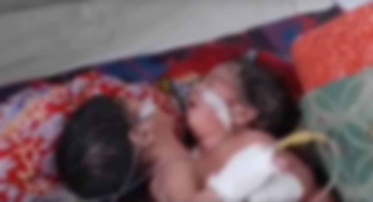 নোয়াখালীতে জোড়া লাগা যমজ শিশুর জন্ম