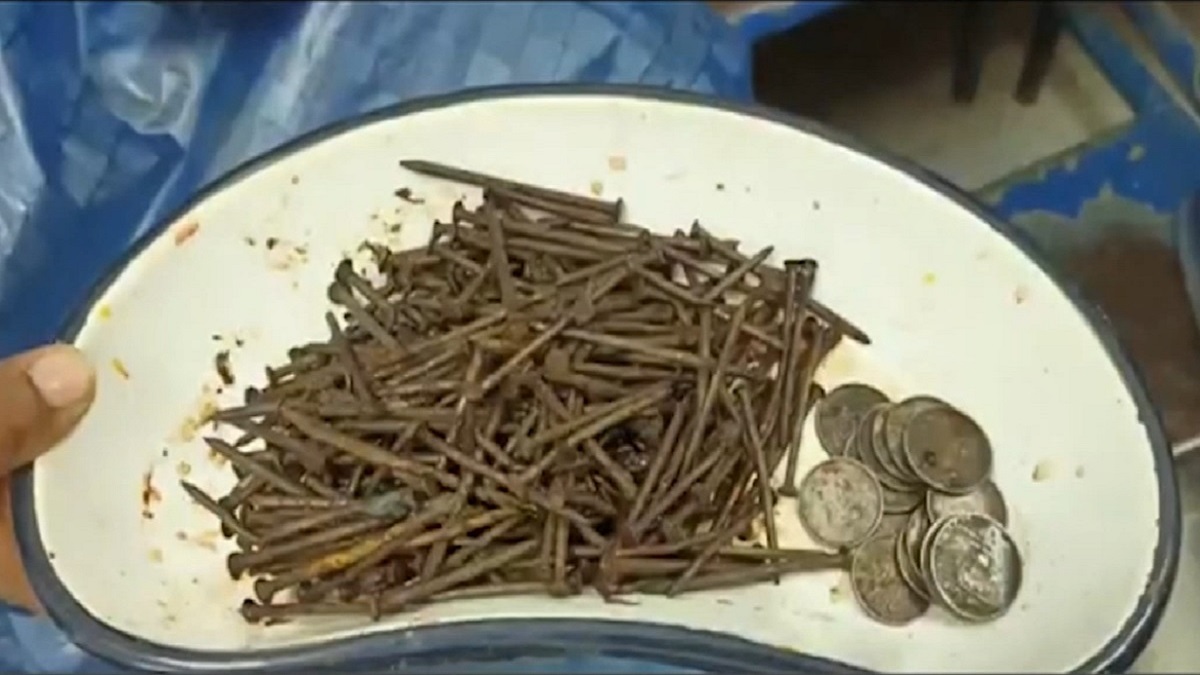 ২৫০টি পেরেক ও কয়েন খেয়েও বেঁচে আছেন মানসিক রোগী, বের হলো অস্ত্রোপচারে