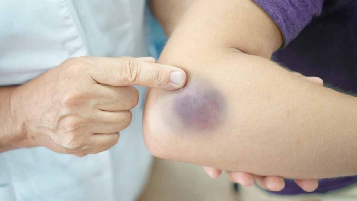 অল্প আঘাত লাগলেও কালচে দাগ পড়ে যাচ্ছে? হতে পারে জটিল রোগ!
