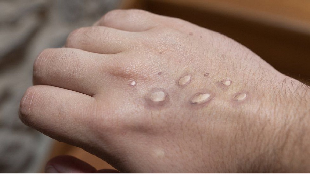 যুক্তরাষ্ট্রে মাঙ্কিপক্সে আক্রান্ত হলো ২ শিশু