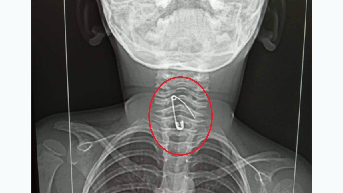 নুডুলস খাওয়ার সময় গলায় আটকে গেলো সেফটিপিন