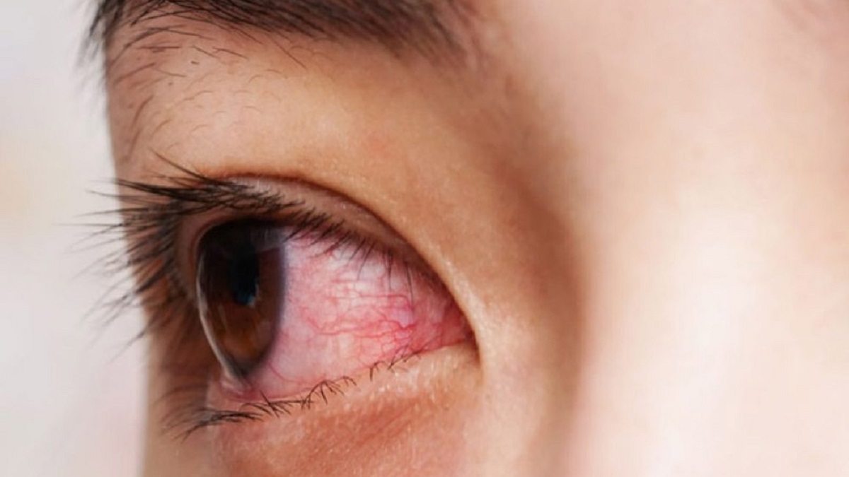 চোখ উঠলে করণীয়