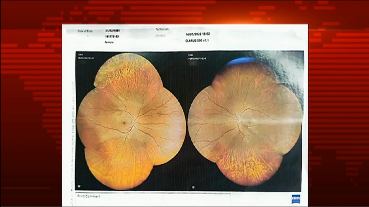 ভুল চিকিৎসায় দৃষ্টিশক্তি হারানোর অভিযোগ চিকিৎসকের