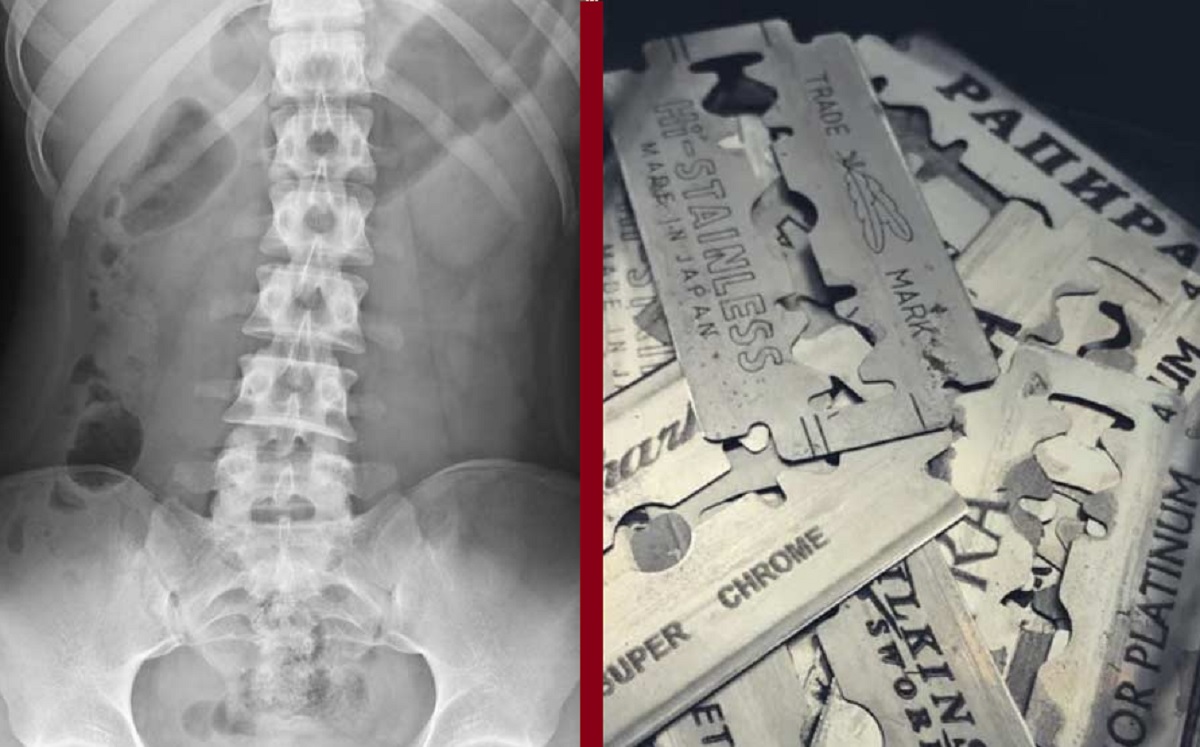 অস্ত্রোপচারে যুবকের পেট থেকে বের হলো ৫৬ টুকরা ব্লেড!