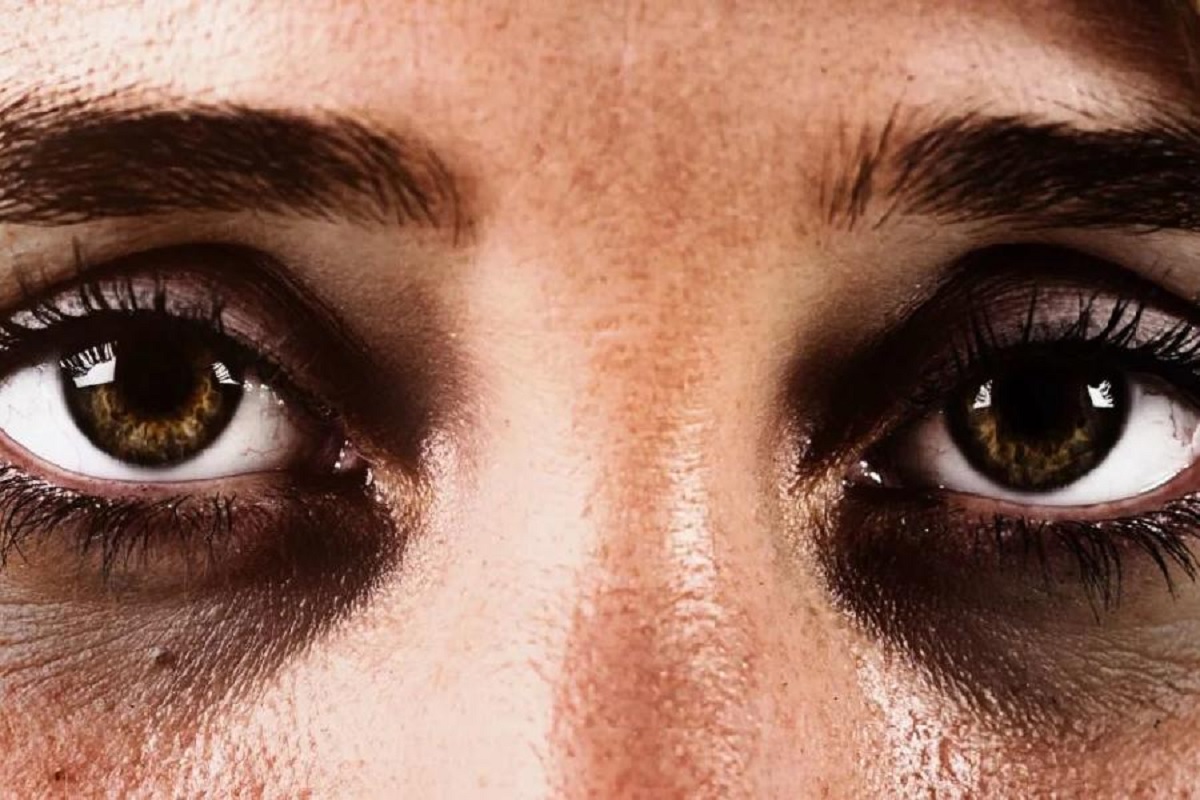 চোখের নিচে কালো দাগ, কীভাবে এই সমস্যা থেকে মুক্তি পাবেন?