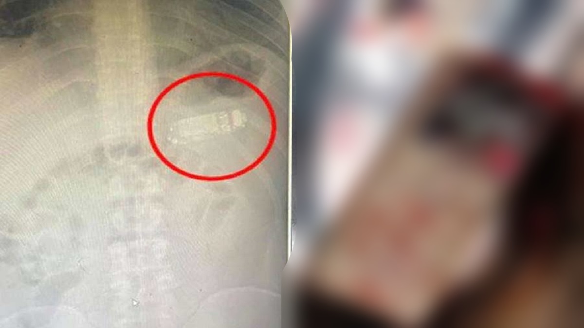 রেগে মোবাইল গিলে ফেললেন তরুণী