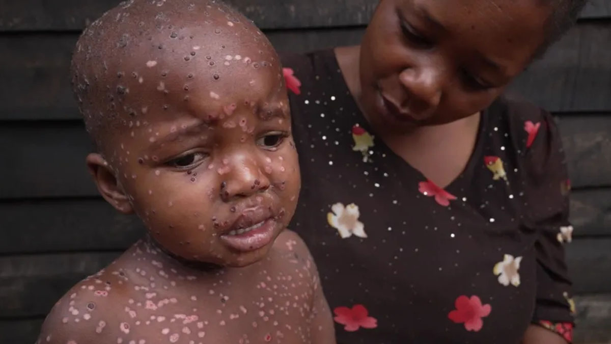 এমপক্স রোগে সবচেয়ে বেশি আক্রান্ত হচ্ছে শিশুরা: বিবিসি