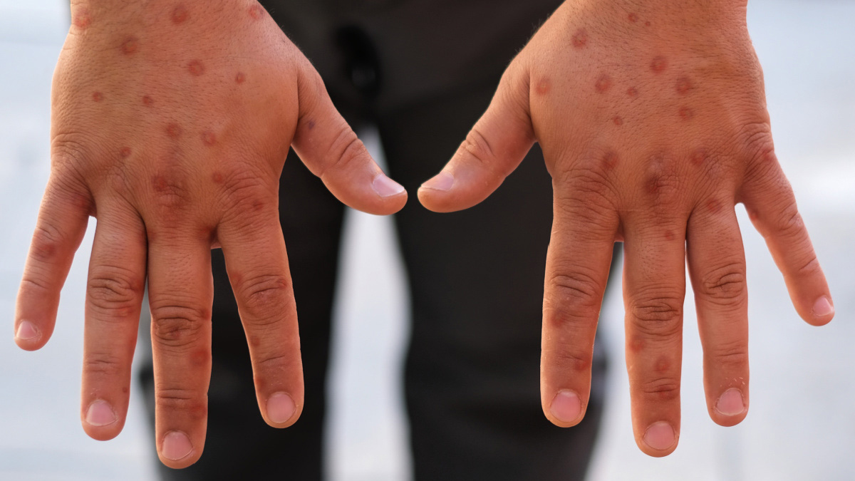 ‘কোভিডের মতো প্রাণঘাতী নয় এমপক্স’