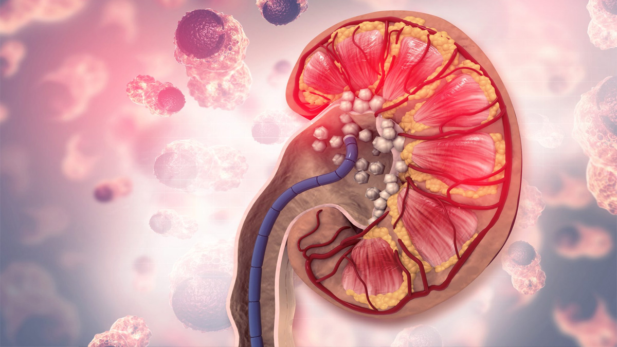 কিডনিতে পাথর প্রতিরোধে এড়িয়ে চলুন এই ৭ অভ্যাস