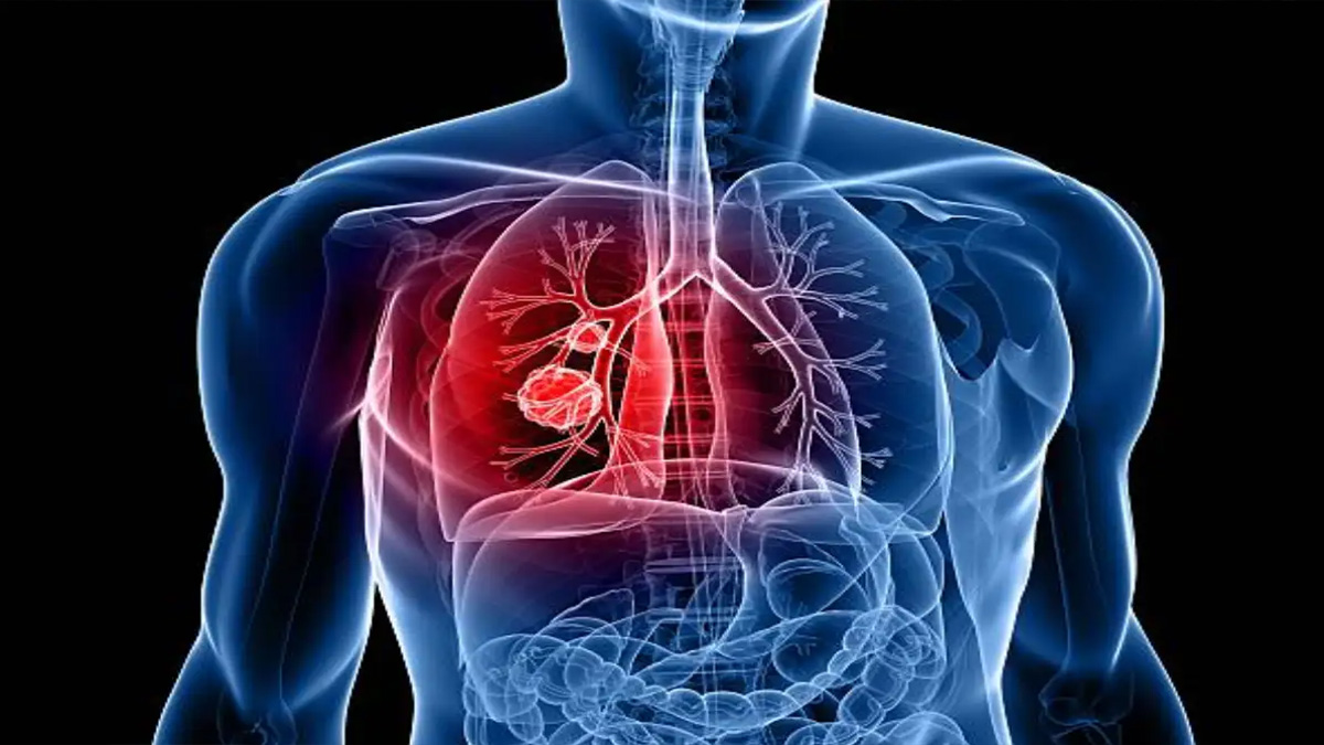 তরুণদের মধ্যে ফুসফুস ক্যান্সার বাড়ছে, কারণ ও প্রতিরোধের উপায়